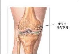 原發性骨關節炎