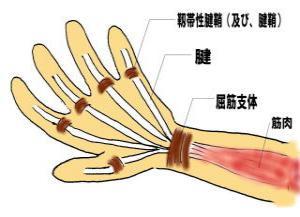 急性纖維性腱鞘炎