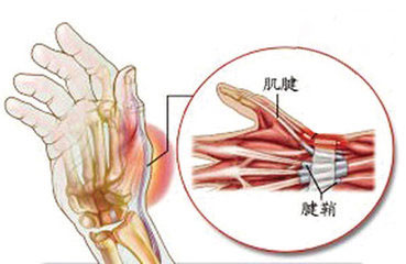 急性漿液性腱鞘炎