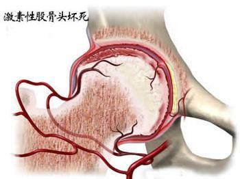 激素性股骨頭壞死