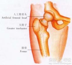 治療股骨頭壞死再不怕動手術