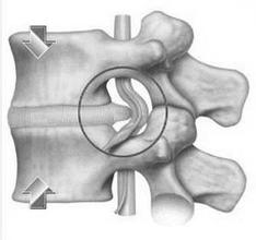 腰間盤突出的治療方法都有什么