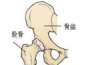 為什么骨壞死容易發生在股骨頭