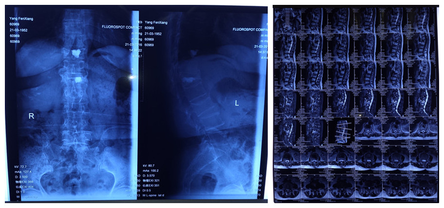患者術前CT及核磁顯示患有陳舊性椎體壓縮性骨折