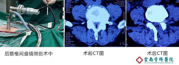 云南中德骨科醫院腰椎間盤突出微創術康復案例 (3)