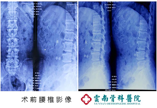 一次手術，幾根釘棒撐起老人幸福晚年 (3)