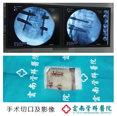 一次手術，幾根釘棒撐起老人幸福晚年 (1)