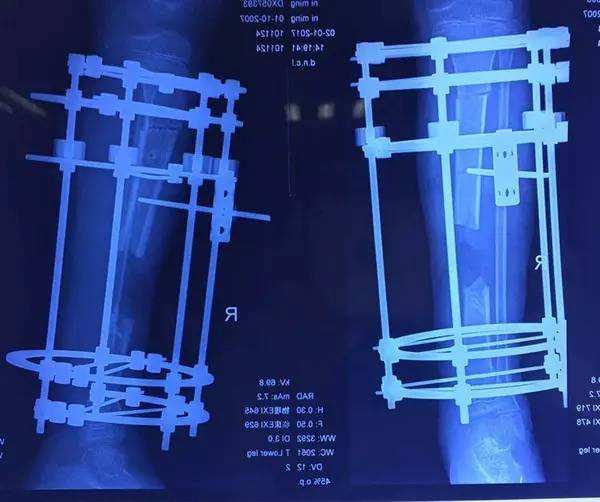 云南中德骨科醫院ILIZAROV技術治療骨缺損骨感染