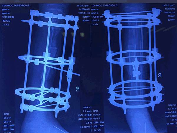 云南中德骨科醫院ILIZAROV技術治療骨缺損骨感染 (2)