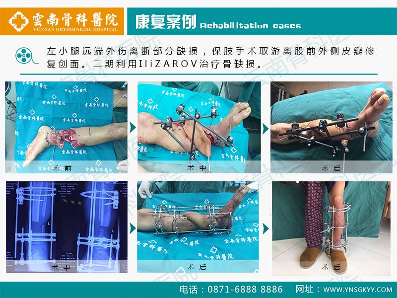 云南中德骨科醫院ILIZAROV技術治療骨缺損骨感染 (1)