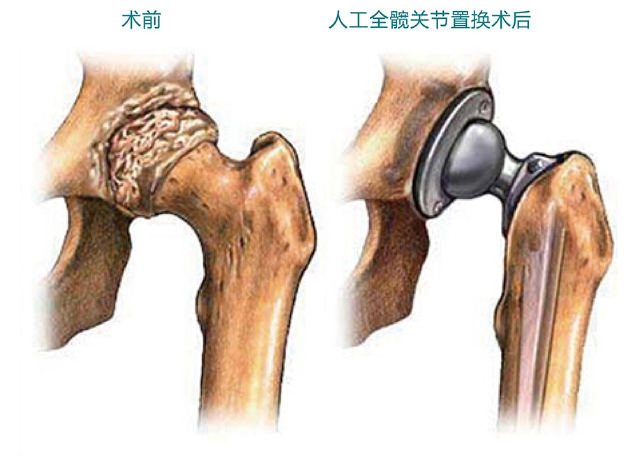 股骨頭壞死人工關節置換術