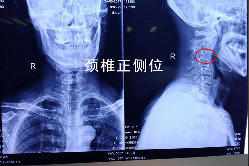 老人頭痛頭暈多年，先進微創技術解決頑固頸椎疾病