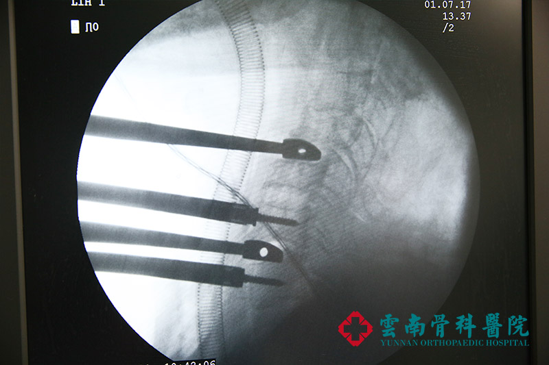 65歲老人腰椎滑脫腰痛難忍，釘棒內固定植骨融合解決腰椎大問題2