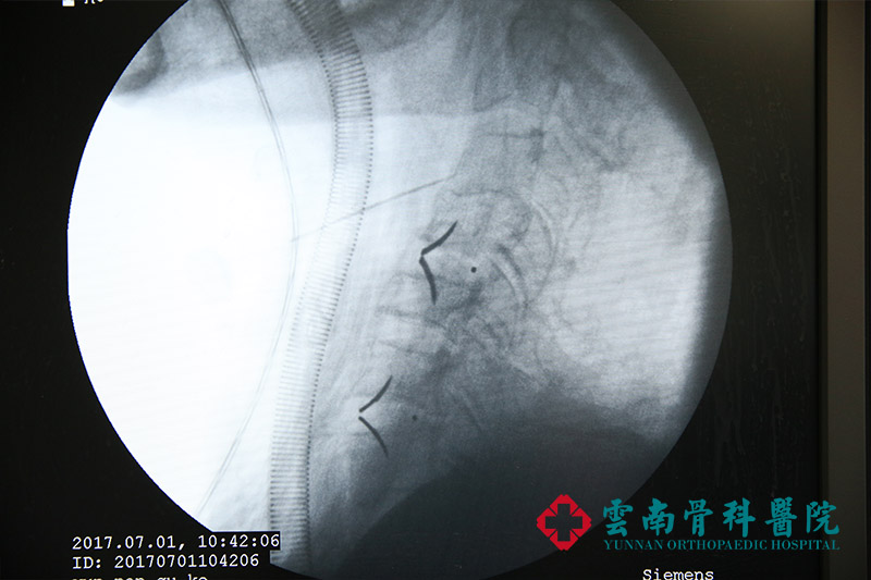 老人頭痛頭暈多年，先進微創技術解決頑固頸椎疾病 (3)