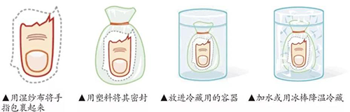 斷指保存1